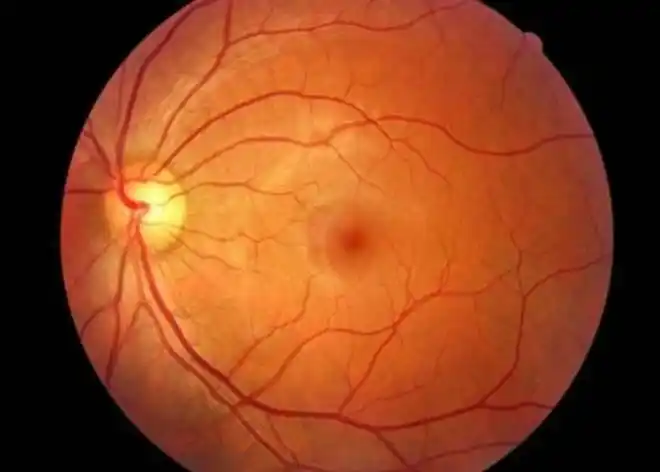 黄斑变性是什么医生这个黄斑疾病严重者会失明