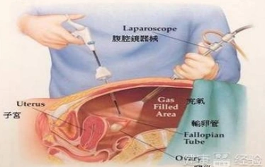 女性输卵管结扎复通手术要避免"二次损伤"