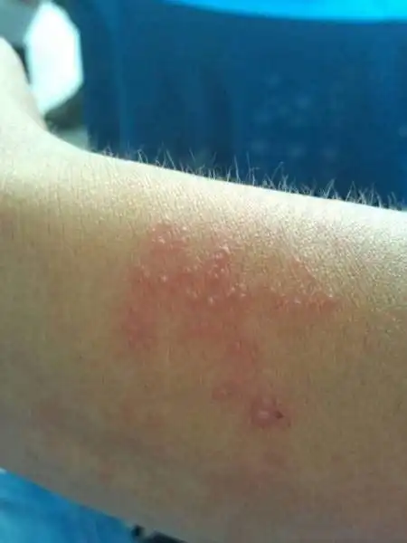 儿童白血病的早期症状皮肤儿童白血病的早期症状七个典型表现要牢记