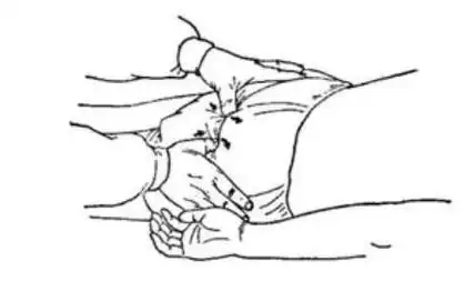 梨状肌综合征是一个很适合手法治疗的疾病,具体手法也很简单易学,可以