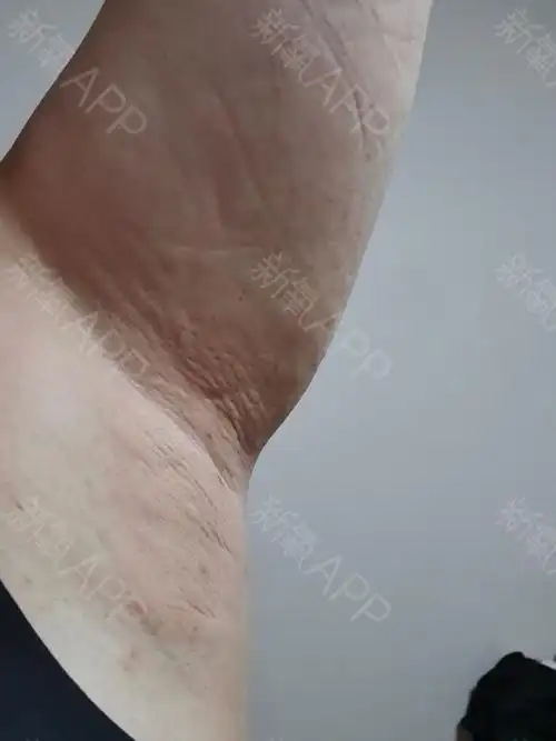 早上洗完澡之后肿胀的副乳部分慢慢开始消肿了腋窝里侧_圈子-新氧美容