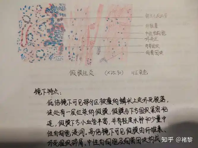 有没有人有病理的结肠腺癌红蓝铅笔手绘图啊? - 知乎