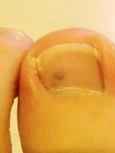 大母脚趾头指甲里面长了一个黑点 是什么阿? 没挤没碰阿