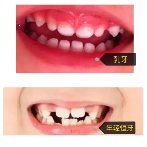 儿童牙齿外伤分为乳牙外伤和年轻恒牙外伤.