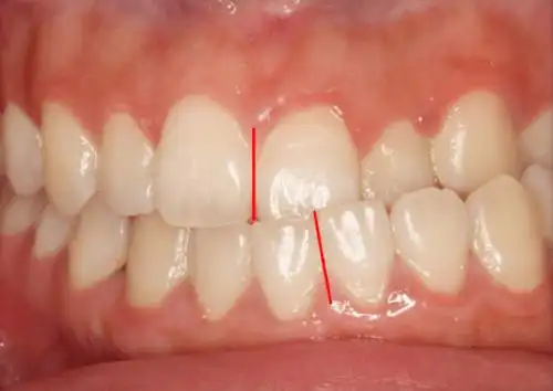 正畸正颌联合治疗,偏颌少女改变人生