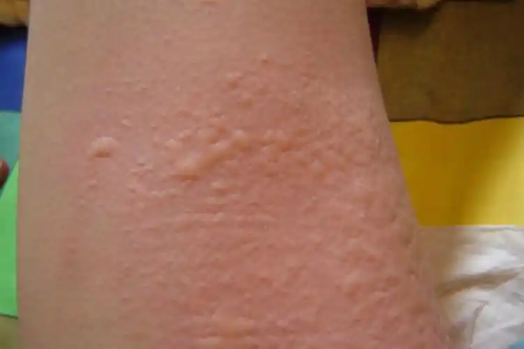 吃螃蟹起红疙瘩