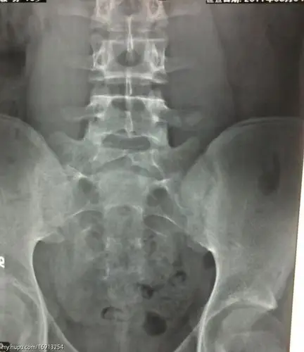 隐性脊柱裂的介绍