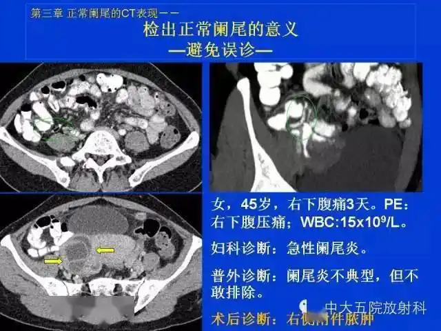 全面详解正常阑尾和阑尾炎的ct表现