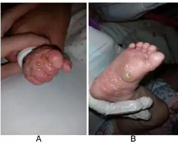 病例报道:罕见的小儿大疱性类天疱疮一例