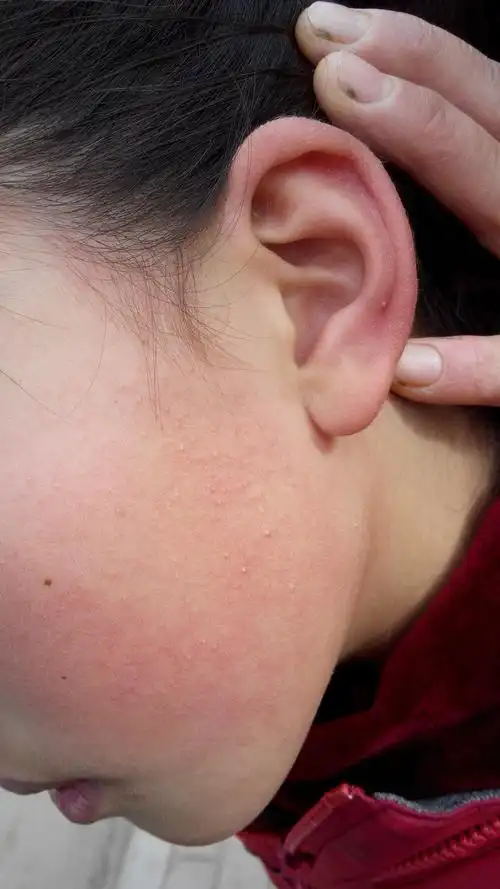 儿童脸部皮肤长痘!