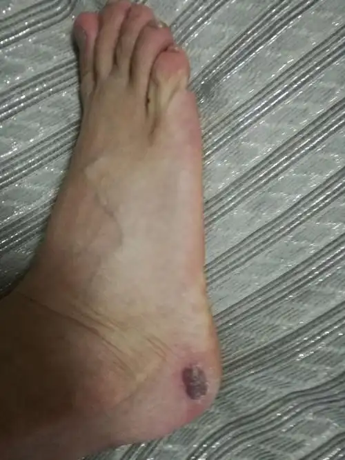 可怜了,我的脚这么大的一个血泡