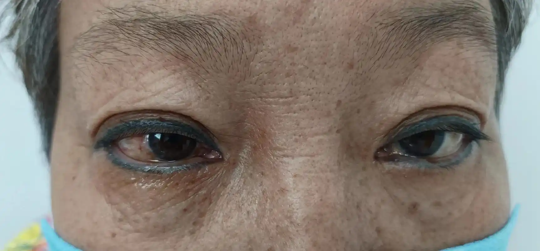 图1;右眼糖尿病并发新生血管性青光眼,胀痛,眼压50mm.  - 抖音