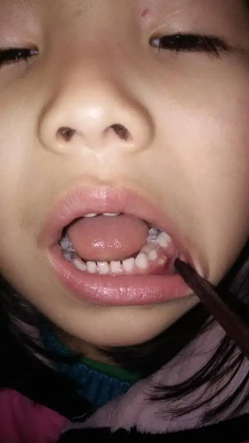 五岁女孩,有一个牙齿去年做了根管治疗,今天那个牙齿的牙龈又长了脓包