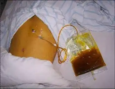 看看哪些人容易得胆结石,在日常生活中要怎么护理?