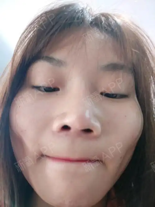 嘉兴艺星,整容失败,鼻翼没缩,假体快顶出来了 耳软骨放歪了