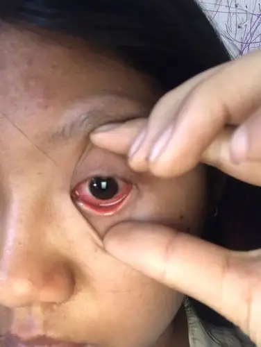 时不时的感觉眼角哪里像是东西遮住的感觉,是什眼睛疼红肿,.