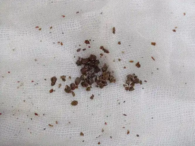 结石引起的肾绞痛怎么治?誉美泌尿外科用这招轻松碎石还无创口哦