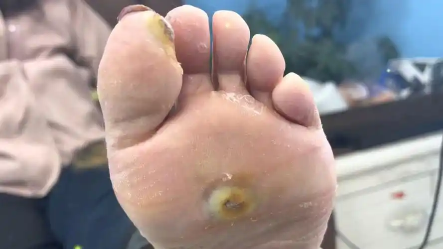 足底跖疣扎根很深,小心挖出来