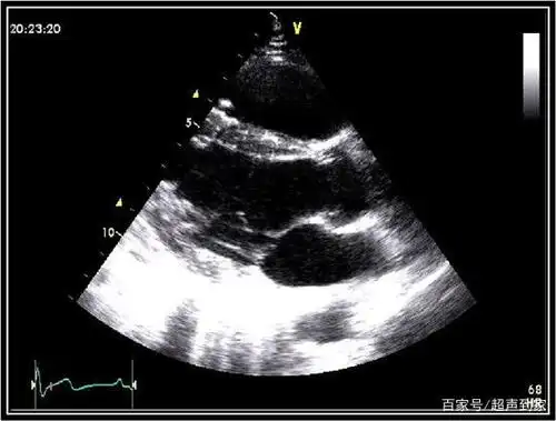 心脏的胸骨旁长轴切面(b型)