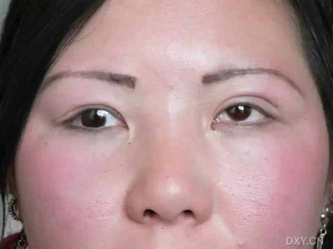 用力睁眼,睑下垂完全消失,右眼反而大.