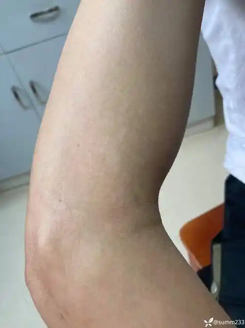 性病>帖子详情>青年男性,双手肘白斑2个月,真菌阴性,是炎症后色素减退