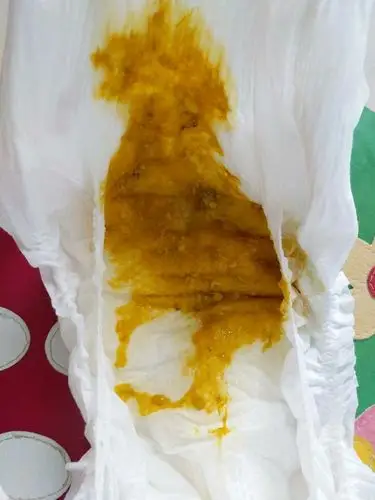 三个月宝宝拉这种便便正常吗?如何改善?纯母乳喂养