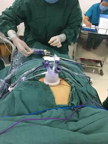 单孔腹腔镜作业