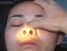 鼻粘膜溃疡是指鼻粘膜下有结节性浸润,继而糜烂,可导致瘢痕性粘连.