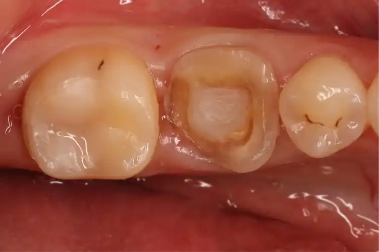 刘芮46 慢性根尖周炎伴外吸收 优韧瓷高嵌体