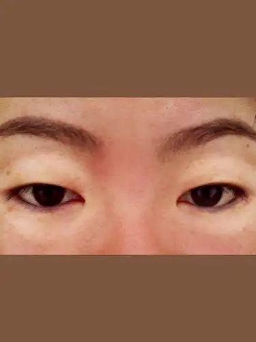 我眼周长了一圈白的不知道是什么,谁能告诉