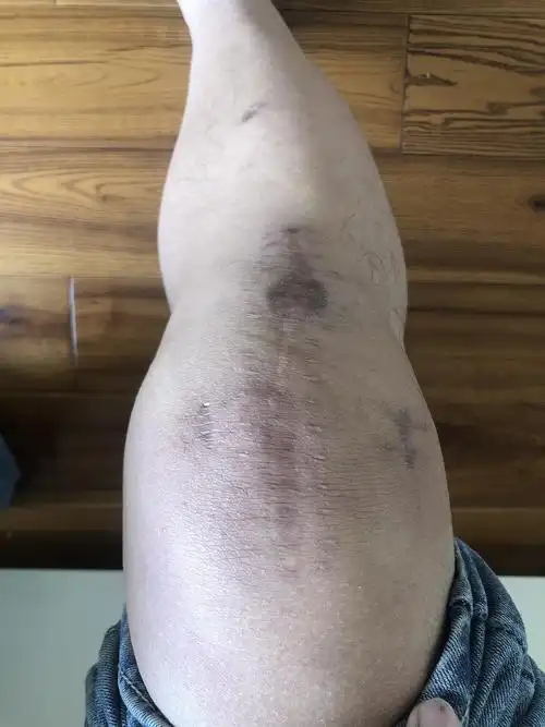 髌韧带断裂对就是膝盖上最粗的那个断了2年恢复后目前基本正常