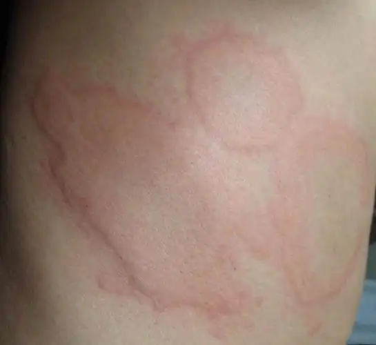 湿疹图片