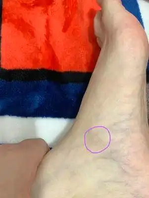 脚内侧足舟骨位置疼有知道是怎么回事的吗