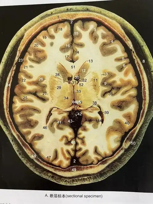 脑室前角14扣带回15额内侧回16扣带沟17大脑前动脉18额上回19额中回20