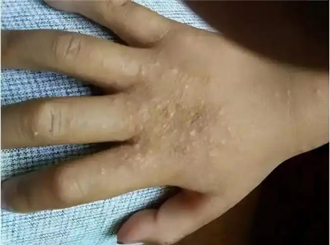 新生儿汗疱疹图片及症状(夏天孩子身上常见的几种小疙瘩,再痒也别抠