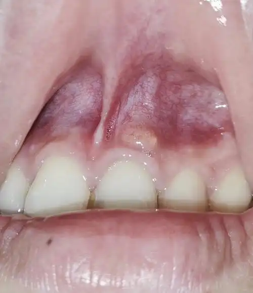 牙龈长了个脓包有图慎入