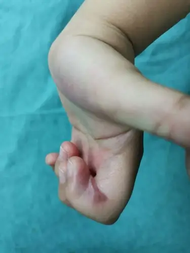 重度手瘢痕挛缩畸形 (原创)