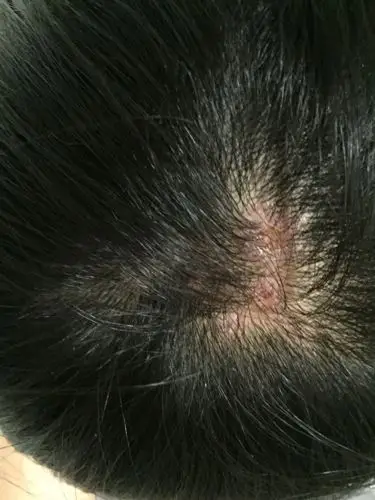 我的头皮上之前长了一些小疙瘩,没有颜色就是头皮上突起来了,也不掉