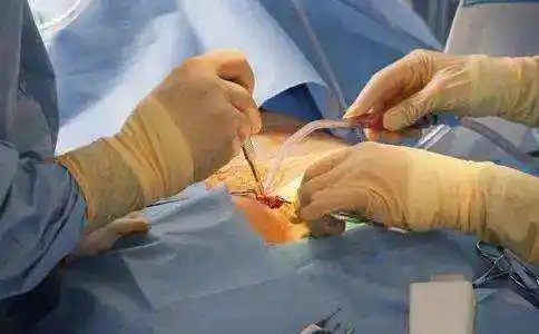 如果有人想看男性结扎手术视频,现在有好多动画版的或者3d版的可以