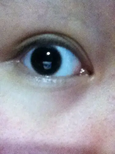 如图 眼头那里有一个小肉球 很长时间了不知道是什