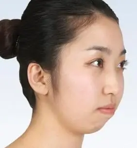 隐形矫正威力大,破解"嘴凸"很管用