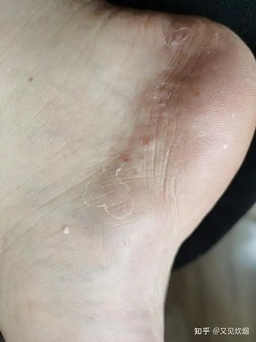 这是汗疱疹还是脚气? - 知乎