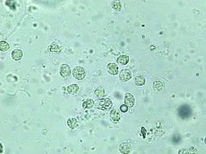 阴道清洁Ⅲ度:少量阴道杆菌和上皮细胞,大量脓细胞和其他杂菌阴道清洁
