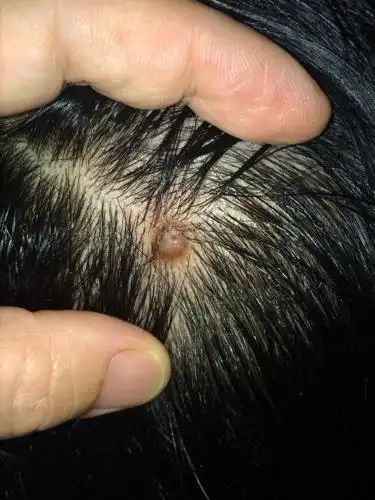 我目测不是疣,因为我以前得过