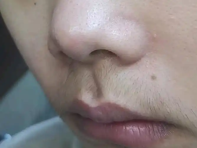 【脱唇毛7天】观察过别的女孩子,嘴唇上也有小绒毛,_圈子-新氧美容