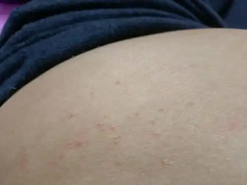 不知道为啥我肚子上长这种小疙瘩了你们长了吗有没