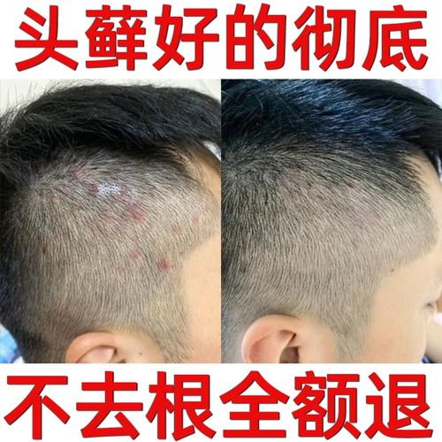 去头藓头屑头痒头皮癣专用药膏银屑病头皮真菌感染白癣药膏洗发水