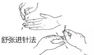 针刺前准备及破皮进针法