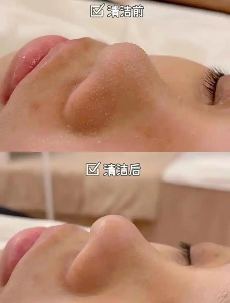 360 度肌底清洁简单粗暴对比图#痘痘黑头粉刺拜拜#深层毛孔 - 抖音