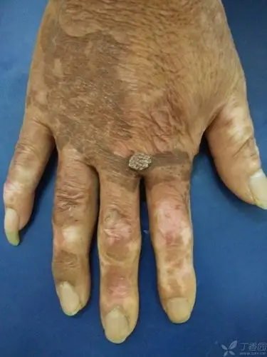 手部菜花状肿物一例 [病例帖]